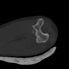 SPORK, NICO - 22.03.1976 - 02.08.2022 - CT obere Extremität - 18:02:23